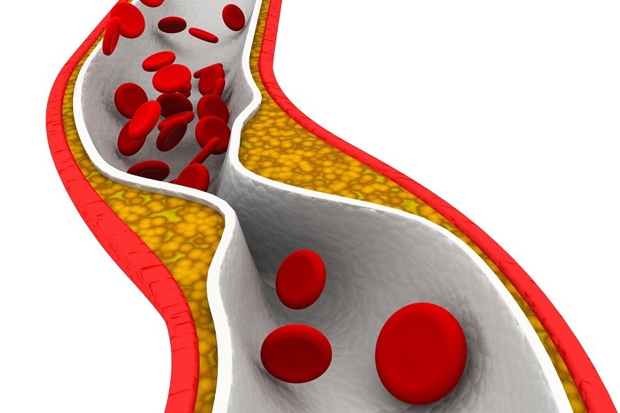 Blood pressure essentials-CHOLESTEROL RELIEF-1B-cholesterol lowering supplements