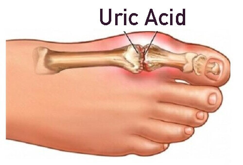 antioxidant formula – Uric Acid Formula 1430mg – soothe inflammation 1 Bottle
