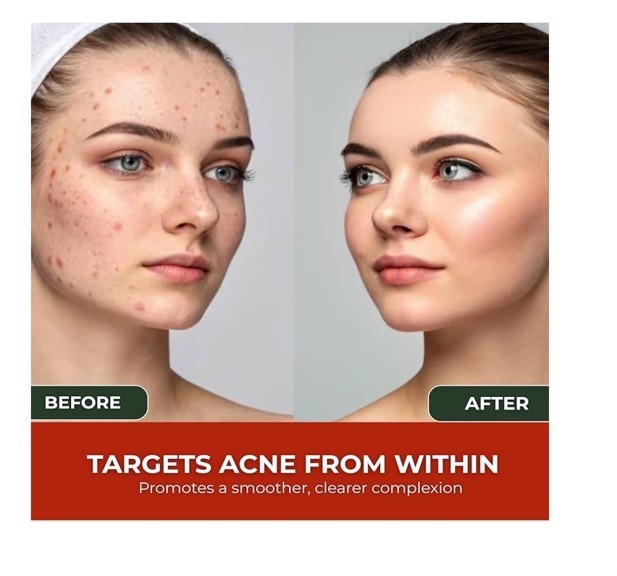 Acne Cleanse Capsules.Organic Vitex Angus Extract, Niacinamide, Biotin for Teens