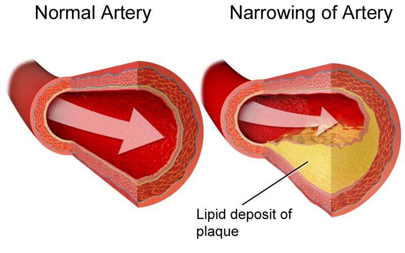 Blood pressure essentials-CHOLESTEROL RELIEF-1B-cholesterol lowering supplements